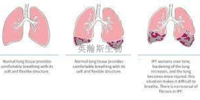 山西比较好的肺纤维化模型是哪家,肺纤维化模型